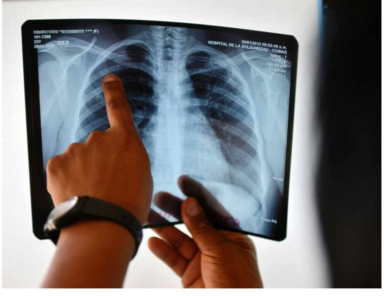 TUBERCULOSIS: LOS CASOS SIGUEN EN AUMENTO EN ARGENTINA Y CRECE LA PREOCUPACIÓN